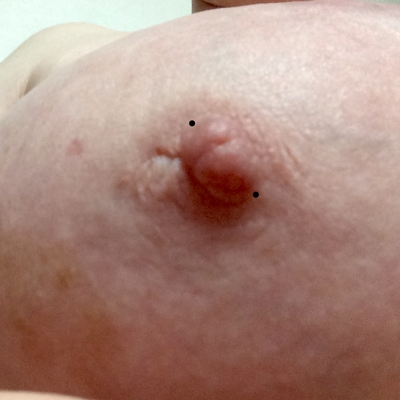 Post surgical Nipple Piercing Elayne Angel s Piercing